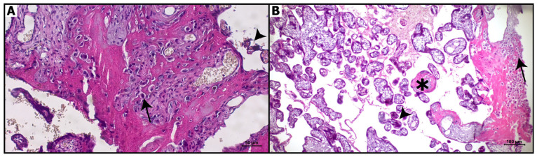 Hematoxylin and eosin staining of placental sections. (A): Control group: Normal appearance of decidual cells (arrow) and chorionic villi (arrowhead), Bar: 50 μm (magnification: 20×). (B): COVID-19 group: Pyknotic nuclei of decidua cells (arrow), fibrinoid deposits (asterisk), and syncytial knots (arrowhead). Bar: 100 μm (magnification: 10×).
