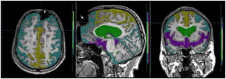 A case of discrepancy in DESH determination between AI and expert. MRI of an 84-year-old male volunteer, who claimed no specific history of head trauma showed a signal deficit (white arrow) in the left frontal region due to a metal artifact. The AI automatically judged the presence of DESH (softmax probability score: 1.0), VD (1.0), SFD (0.75), and the absence of THC (0.84), while the expert judged the presence of VD but not DESH, THC, or SFD. This case should have been excluded from the study.