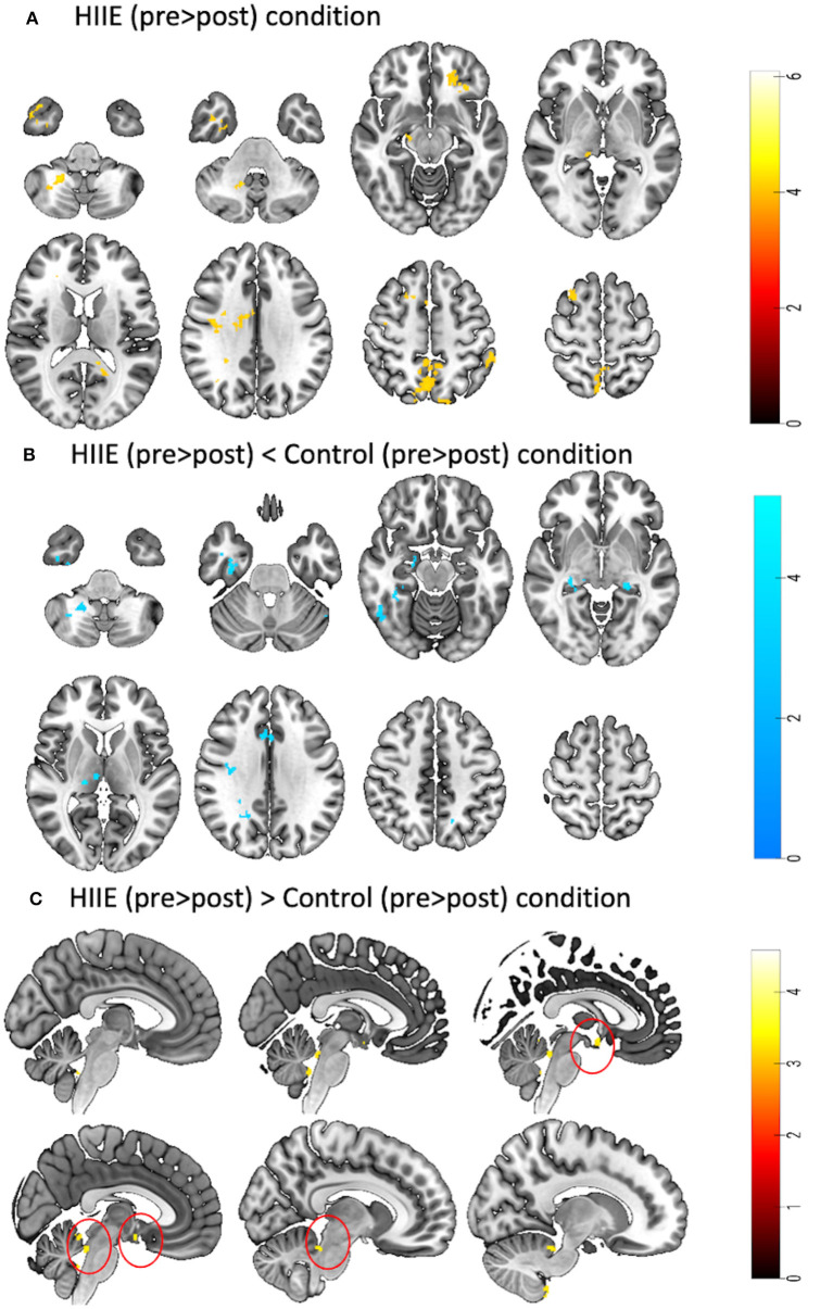Represents a 2 × 3 repeated measures ANOVA to compare time and condition effects on zfALFF: (A) Results from within condition showing clusters where zfALFF was reduced after the HIIE (p < 0.05, k = 101), (B) Results from between condition showing clusters where zfALFF was reduced after the HIIE condition compared to control (p < 0.05, k ≥ 90), and (C) Results from between condition showing clusters where zfALFF increased after the HIIE condition compared to control (p < 0.05, k ≥ 148). zfALFF, normalized fractional amplitude of low frequency fluctuations; k = cluster size. The color bars represent the t-statistics of corresponding test.