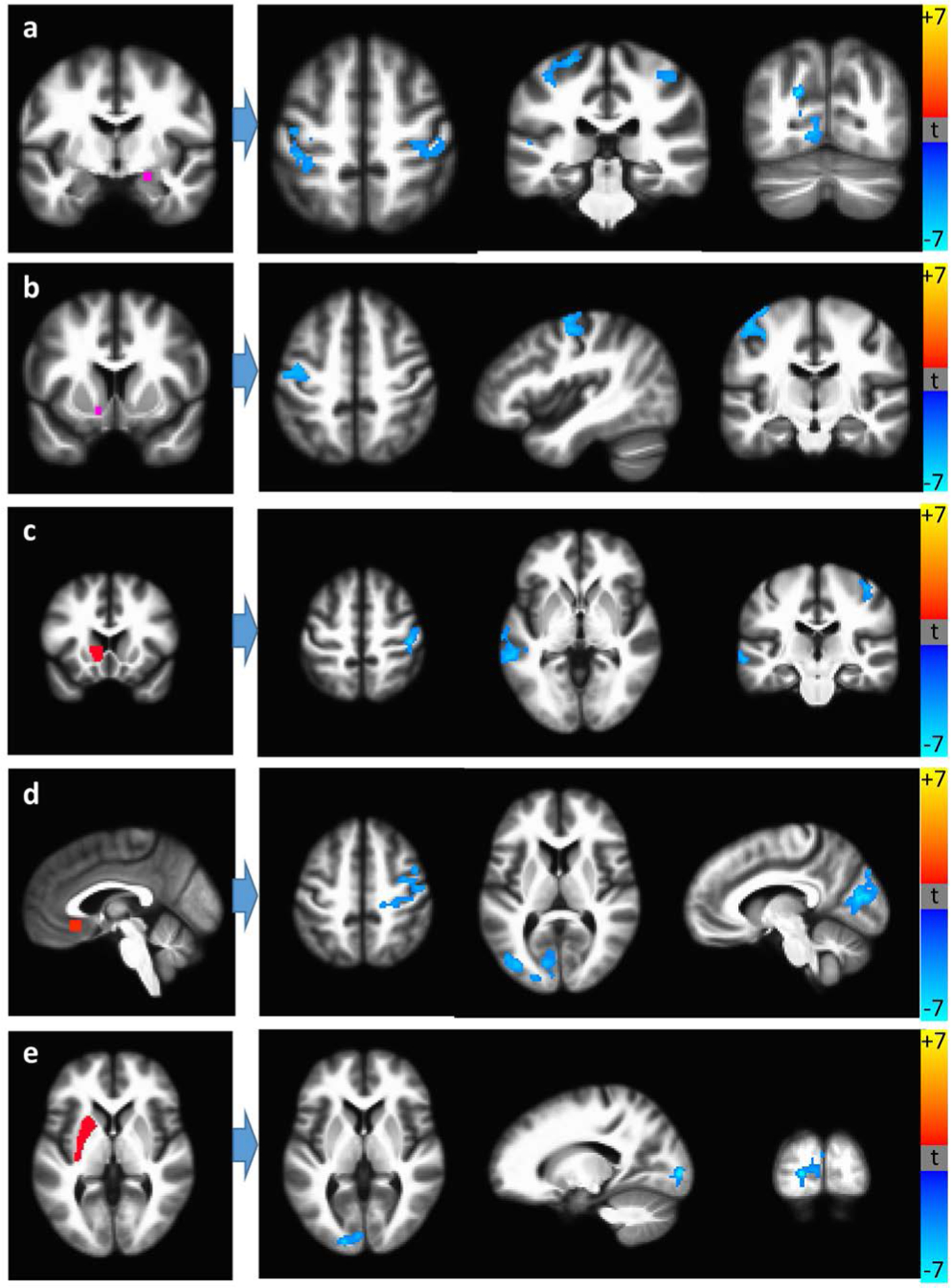 HIV+ recent cannabis users (N = 10) have lower RSFC compared to HIV+ remote users (N = 11) between (a) the right central amygdala (seed) and bilateral pre-central gyrus, left occipital cortex, central nucleus of the amygdala; (b) left nucleus accumbens (seed) and left pre-central gyrus; (c) left caudate head (seed) and right post-central gyrus, left middle temporal gyrus; (d) subgenual anterior cingulate (seed) and bilateral and medial occipital cortices, right post-central gyrus; (e) left putamen (seed) and left medial occipital cortex. Seed regions are shown on the left.
