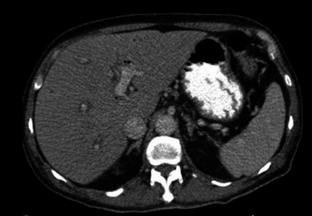 The CT scan showed evidence of pneumobilia in biliary ducts