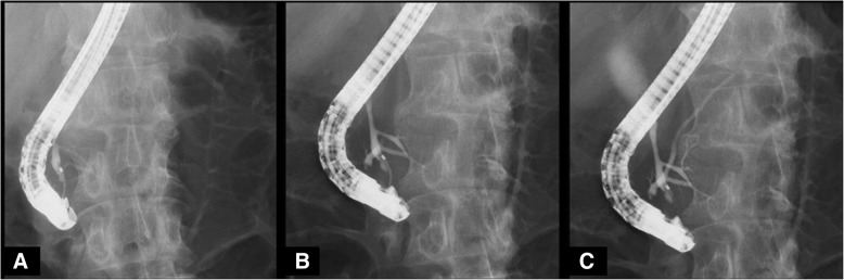 Endoscopic retrograde cholangiopancreatography (ERCP). ERCP from the papilla of Vater revealed the pancreatic main duct via the pancreatic branch duct (a and b). Pancreaticobiliary maljunction with dilatation of the common bile duct (26 mm) and incomplete pancreas divisum were revealed (c)