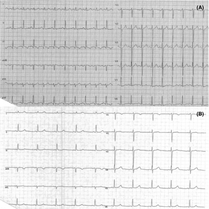A, the ECG shows sinus tachycardia at 126 beats per minute and repolarization abnormalities in the inferior leads. B, the ECG was repeated 12 hours later and presented a normal heart rate and the resumption of a normal repolarization in the inferior leads