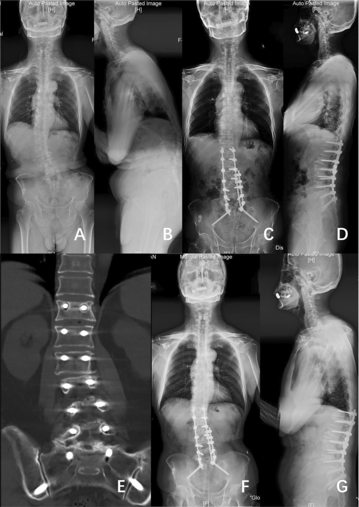 Case example of a 74‐year‐old male with DLS who underwent surgical correction consisting of T12‐S2AI posterior surgery. (A and B) Full‐length standing posteroanterior and lateral radiographs before operation (Cobb 18.6°, CDB 15.39 mm, PI 49.1°, PT 35.3°, SS 12.7°, TK 21.4°, LL 5.5°, SVA 173.56 mm). (C and D) Posteroanterior and lateral standing radiographs 1 year after operation (Cobb 5.5°, CDB 13.22 mm, PI 44.6°, PT 25.0°, SS 20.7°, TK 33.0°, LL 29.6°, SVA 15.82 mm). (E) T12 screw loosening was found 1 year after surgery by CT. (F and G) Posteroanterior and lateral standing radiographs 2 years after operation (Cobb 7.5°, CDB 10.06 mm, PI 47.7°, PT 28.4°, SS 15.6°, TK 29.9°, LL 26.1°, SVA 76.16 mm).