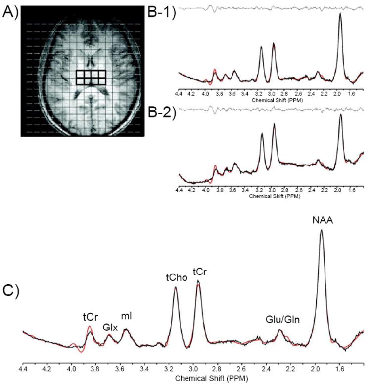 (A-C) A. Axial T1-weighted representative image depicting MRSI grid with voxels positioned in the left and right thalamus, and corresponding J=0.0 Hz sample spectra from voxels in the left (B-1) and right (B-2) thalamus. C. J=0.0 Hz spectrum shown with LCModel fit and labeled metabolites.Abbreviations: Cr: Creatine; Cho: Choline; ML: Myo-Inositol; NAA: N-acetyl-aspartate; Glu: Glutamate; Gln: Glutamine