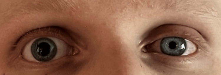 Photograph of Horner’s syndrome. The image reveals marked anisocoria, miosis, and partial ptosis of the left eye.
