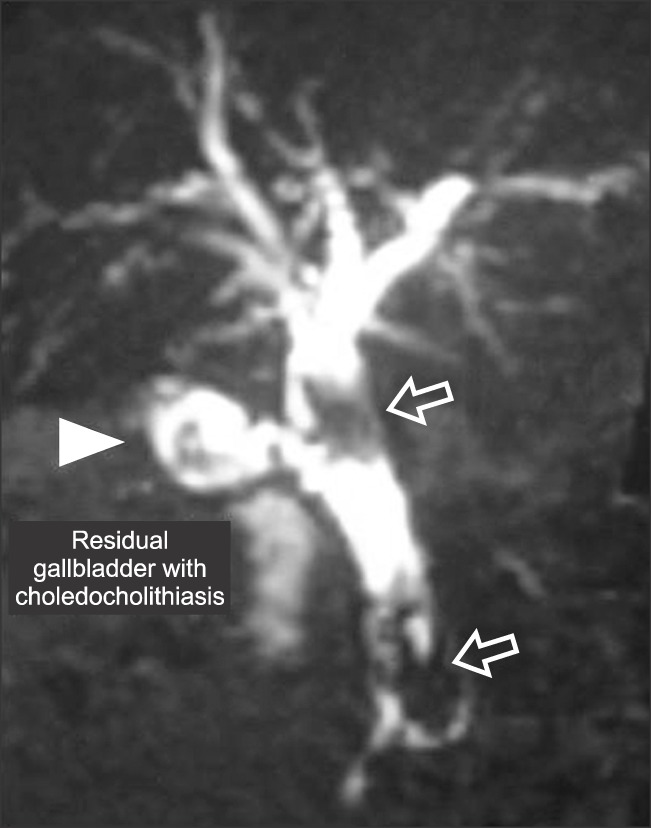 MRC reconstruction displays a residual gallbladder with a stone (marked with solid arrow), as well as choledocholithiasis (marked with hollow arrow).