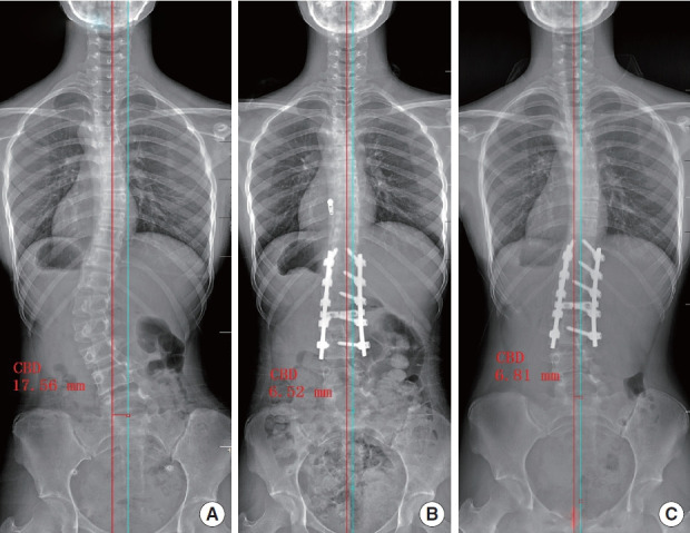 Radiographs of a 14-year-old girl with adolescent idiopathic scoliosis in type A preoperative coronal pattern (A), postoperative (B), and 2-year follow-up (C) images showed well-restored coronal balance. Type A, coronal balance distance (CBD)<20 mm.