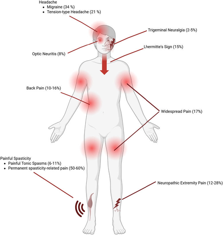 Graphical representation of common pain syndromes observed in multiple sclerosis. Prevalence estimates (in parentheses) are based on Truini et al. Created with BioRender.com.