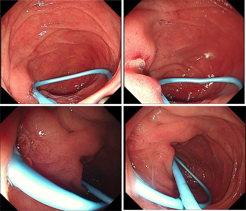 Gastroscopy showing a duodenal descending segment ulcer.