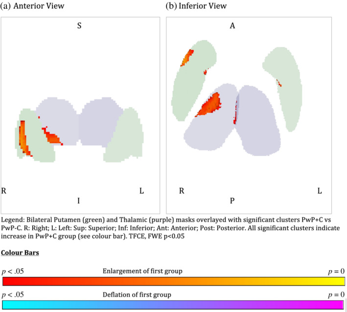 Legend: Bilateral Putamen (green) and Thalamic (purple) masks overlayed with significant clusters PwP + C versus PWP‐C. A, anterior; I, inferior; L, left; P, posterior; R, right; S, superior. All significant clusters indicate increase in PwP + C group (see colour bar). TFCE, FWE p < .05