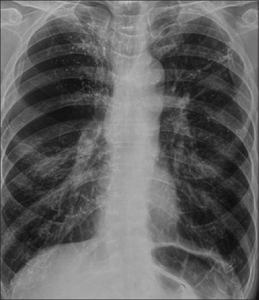 Chest X-ray demonstrating bullae in bilateral upper lobes