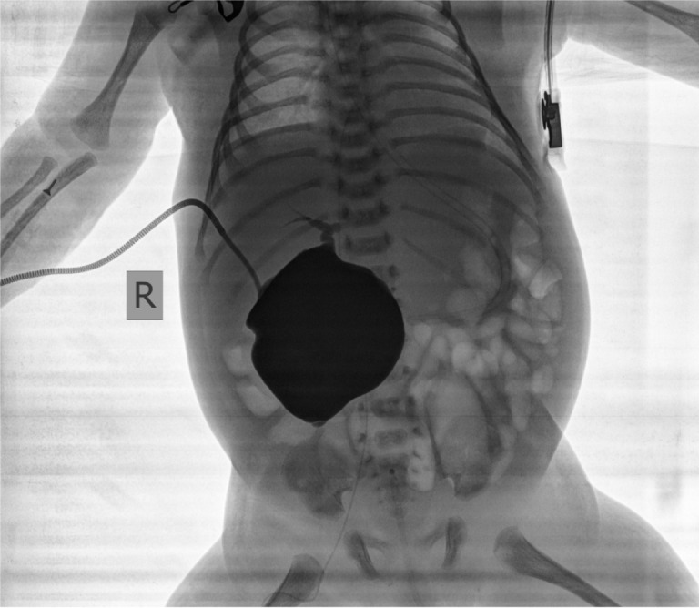 X-ray showed huge cystic dilation of the common bile duct and partial visualization of the common hepatic duct.