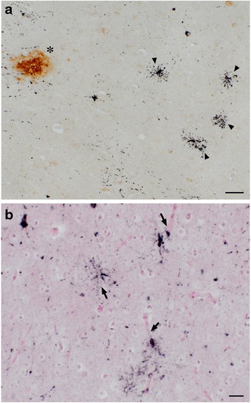 Tau-positive astrocytes around blood vessels. AT8-positive astrocytes (dark purple staining, indicated by arrowheads) were found independently of Aβ deposits (brown staining, indicated by asterisk) in the temporal cortex a. RD4-positive signals (purple staining), but not for RD3 (data not shown), were found close to blood vessels (arrows) in the same region b. Scale bars, a:50 μm, b:20 μm