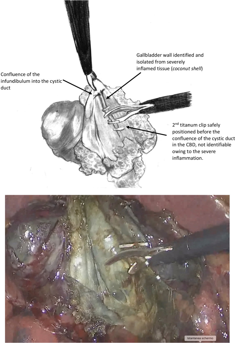 Schematic drawing of the intraoperative view