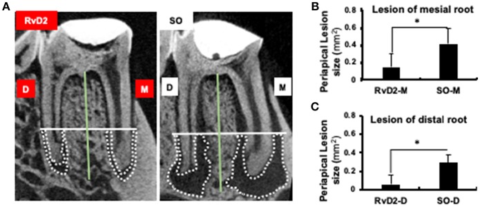Micro-CT analysis of periapical lesions after root canal treatment in rats. (A) Representative image of teeth in the treatment group and SO group. The x-axis (white line) passes through the apical third of the mesial and distal root canal, denoted as the coronal limit of periapical lesion. The y-axis (green line) passes through the center of the mesial and distal root canals of the mandibular first molars. (B,C) Comparison of changes in the size of periapical lesions in mesial and distal canals (*P < 0.05 indicates significant differences compared to the SO group, Mann–Whitney test). Data represent the means of four independent rats (SO on left side and RvD2 on right side for each rat), with error bars indicating standard deviations. The volume of the periapical lesions of the mesial and distal roots for the treatment group were significantly lower than that of the control group after 4 weeks following pulp exposure.