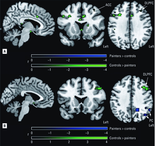 SPM maps corrected for verbal IQ and lead exposure (A) or corrected for verbal IQ, lead exposure, and task performance (B) of significant group differences (p < 0.001) in activation of the working memory network. Green indicates regions where painters had lower activation and blue indicates regions where painters had higher activation, compared with controls.