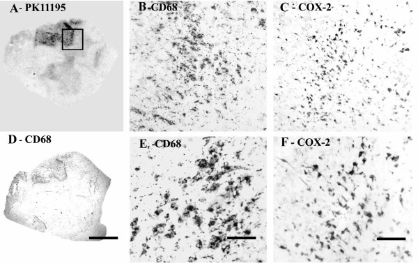 COX-2 immunoreactivity in MS spinal cord is in microglial cells/macrophages. (A) Autoradiographic localisation of 3 [H] PK11195 in a spinal cord from a patient with MS, co-located with CD68 (D) (Scale bars = 1000 μm). The square indicates the area where subsequent CD68 and COX-2 images were taken from. B) And E) Microglial cell/macrophage-like immunostaining with CD68 antibody (Scale bars = 200 μm and 100 μm respectively). C) And F) Microglial cell/macrophage-like immunostaining with COX-2 (Scale bars = 200 μm and 100 μm respectively).