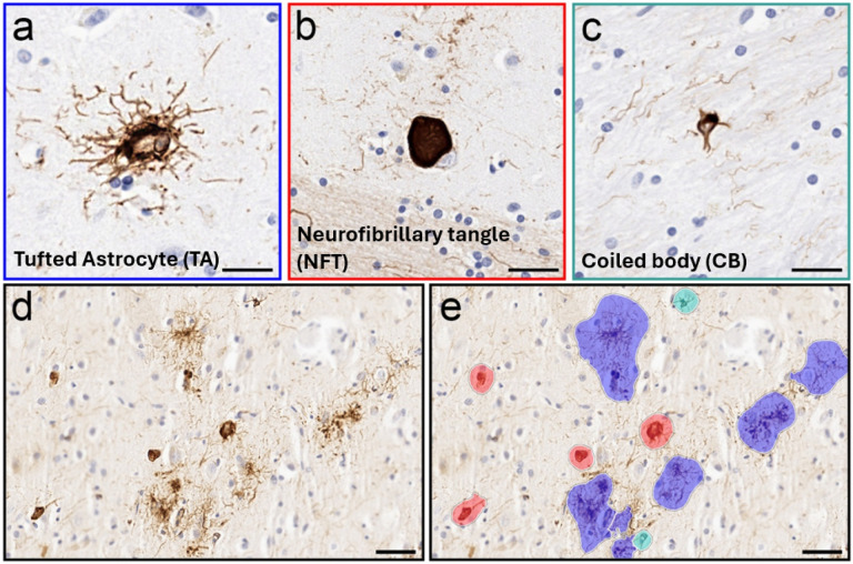 PSP pathology and automated detection and phenotyping of pTau immunoreactive lesions.Representative examples pTau pathology phenotypes and automated detection results. High-magnification examples of pTau-positive morphologies (a-c), including tufted astrocytes (a; TAs; blue), neurofibrillary tangles (b; NFTs; red) and coiled bodies (c; CBs; teal). Panel d shows an unannotated field containing multiple pTau-positive lesions with the corresponding automated detection overlay, with color-coded segmentations identifying lesion classes across the tissue field (e). Scale bars = 50mm (a-c) and 100mm (d-e).
