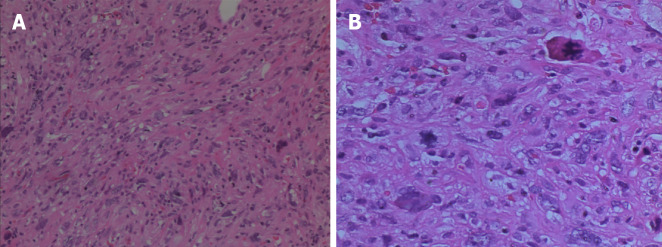 Pathological examination findings. The tumor cells were spindle-shaped or pleomorphic, arranged in sarciniform structure, with deeply stained nuclei, singular nuclei and nuclear division, abundant cytoplasm, and scattered inflammatory cells infiltration. A: Hematoxylin & eosin (H&E) staining, magnification: 100 ×; B: H&E staining, magnification: 200 ×.
