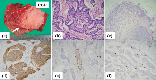 (a) The resected specimen contains a small yellowish submucosal tumor (approximately 7 mm in diameter) located at the ampulla of Vater (arrow). (b) Monotonous tumor cells with small round nuclei are seen (hematoxylin and eosin staining, × 400). (c) Carcinoid tumor cells within a peripancreatic lymph node (× 200). (d) The tumor cells are positive for synaptophysin, a neuroendocrine marker (× 40). (e) Endolymphatic tumor emboli are shown by staining with D2-40 antibody (× 400). (f) Positive staining for MIB-1 antibody is seen in approximately 3.2% of the tumor cell nuclei (× 400).