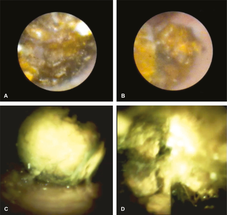 SpyGlass Legacy images (A and B) and SpyGlass DS images (C and D) before and after fragmentation of stone.