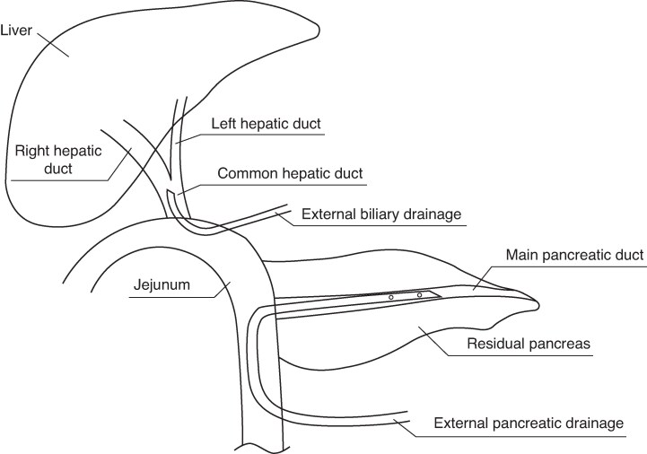 Schematic diagram showing external drainage of the main pancreatic duct and common bile duct