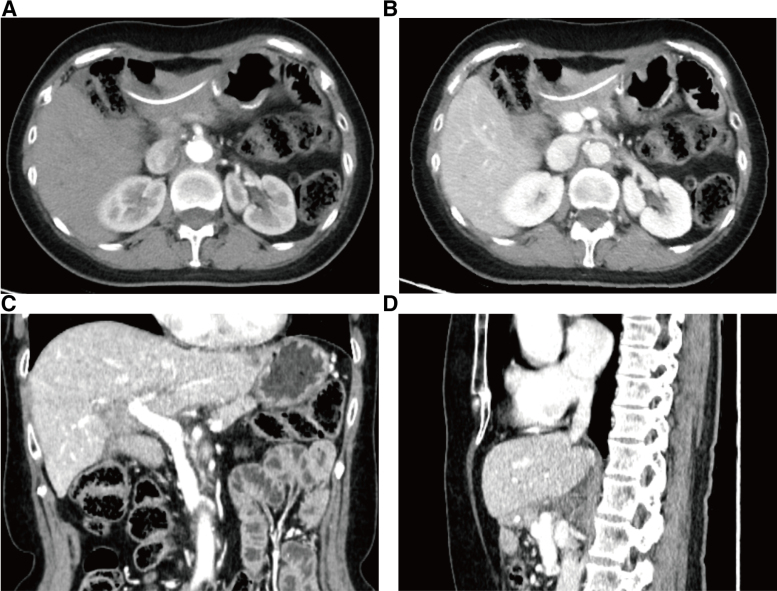 The CT scan image of the patient one year after the operation. (A,B) The CT scan images of the enhanced arterial (A) and venous phases (B) of the patient’s surgical area. (C,D) The CT scan images of the patient’s surgical area in the sagittal (C) and coronal positions (D). CT = computed tomography.