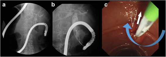 a, b The endoscope reached the second portion of the duodenum by following the lesser curvature, while slowly rotating the endoscope clockwise. c In endoscopic view, the ampulla was shown at the center and upward direction. The bile duct direction (white arrow), catheter device direction (blue arrow), and angle between two vectors (white line) are indicated