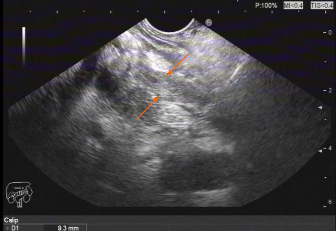 Endoscopy findings. Ultrasound gastroscopy revealed widening of the bile duct wall (arrows).