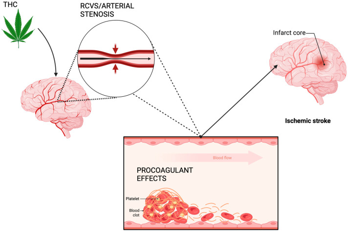 Mechanisms of cannabis-induced angiopathy leading to ischemia.