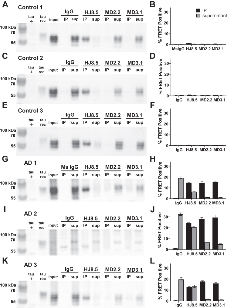 MD2.2 and MD3.1 bind soluble tau AD seeds. Western blots of total tau in the IP and supernatant fractions from immunoprecipitation of three control brains (A, C, and E) and three AD brains (G, I, and K) indicated that MD2.2 and MD3.1 bound no tau from control brains and only a very small fraction of tau from AD brains. By contrast, HJ8.5 bound nearly all tau from all brains. Seeding assays of the IP and supernatant fractions showed that nearly all seeding activity from AD brains was in the IP fractions of MD2.2 and MD3.1, whereas much was left in the supernatant by HJ8.5 (H, J, and L). No significant seeding activity was detected in control brains (B, D, and F). Input was the pre-IP total protein for each brain; tau−/− negative control was the equivalent total protein from a tau−/− mouse brain, tau rec indicates recombinant tau monomer (2N4R). Non-specific mouse IgG was the negative control for immunoprecipitation. Error bars represent the S.E.M. Each assay was performed in technical triplicate.