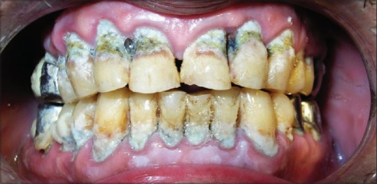 Generalized cervical caries with a very poor oral condition in a 36-year-old patient injected heroin for 8 years