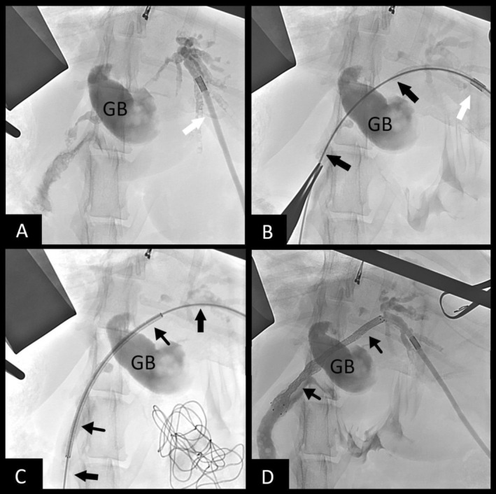 Fluoroscopic images of transhepatic biliary rendezvous technique performed in Case 1. (A)—Fluoroscopic study showing the catheter (white arrow) within the intrahepatic duct, with a successful cholangiogram performed. The gallbladder is denoted as GB. (B)—Passage of the hydrophilic guidewire (thick black arrows) through the CBD and into the duodenum. (C)—Passage of the biliary stent delivery system (thin black arrows) over the wire. (D)—Cholangiogram showing patency of the deployed biliary stent (thinner black arrows) along with final placement of the pigtail catheter within the intrahepatic duct.