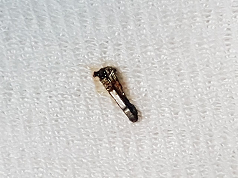 The metallic clip is recognized enclosed in biliary sludge. Notice that the clip is closed but both branches cross, denoting an incorrect closure.