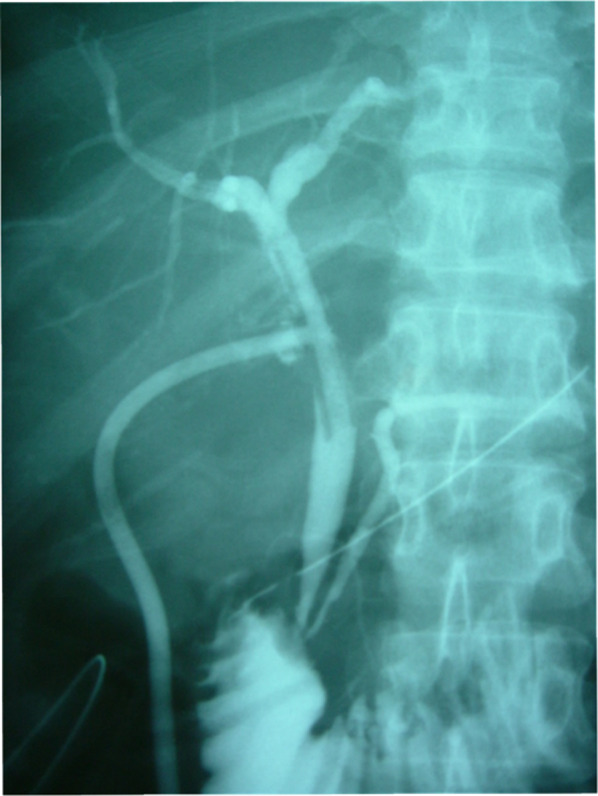 Intra-operative cholangiography. Intra-operative cholangiography revealed no residual stones or abnormalities of the biliary sphincter