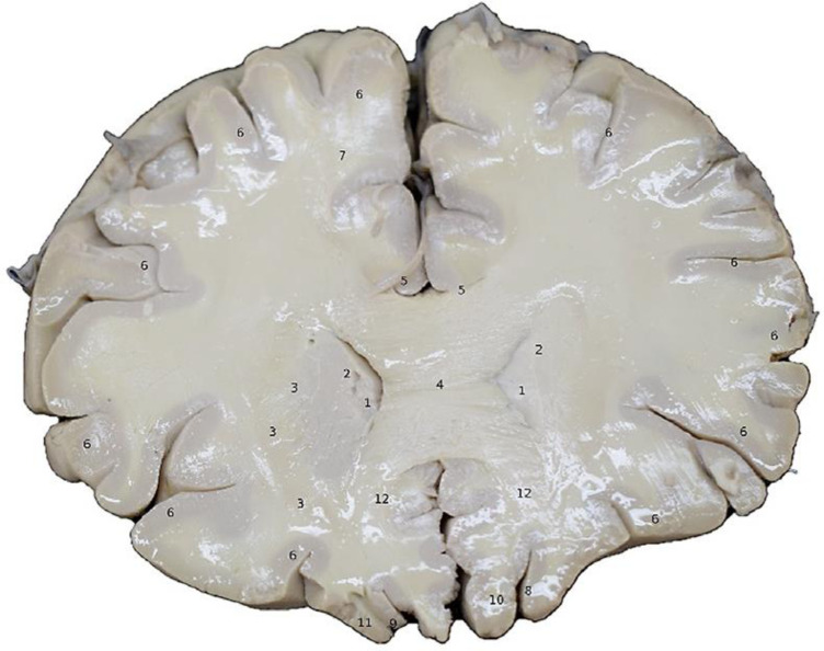 Prefrontal coronal section at the level of the corpus callosum. The following are identified: (1) frontal extension of the cerebral ventricle; (2) head of the caudate nucleus; (3) internal capsule; (4) corpus callosum body; (5) gyrus cinguli; (6) cerebral cortex; (7) radiated crown; (8) olfactory sulcus; (9) olfactory snood; (10) CBD directly affects the dorsolateral and ventromedial cortex of the brain, generating in the patient a dysexecutive syndrome that is related to a deficit in his behavior and/or immediate behavior. Taken from Corina Brain Research. Digital Application. Faculty of Medicine. Universidad Libre-Cali (2019).