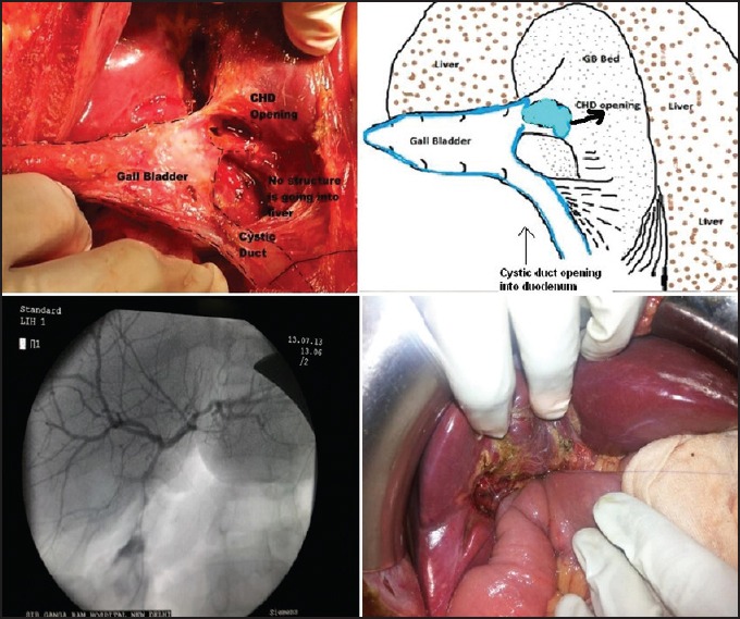 Pictorial description depicting intraoperative gallbladder anatomy, cholangiogram and Roux-en-Y hepaticojejunostomy