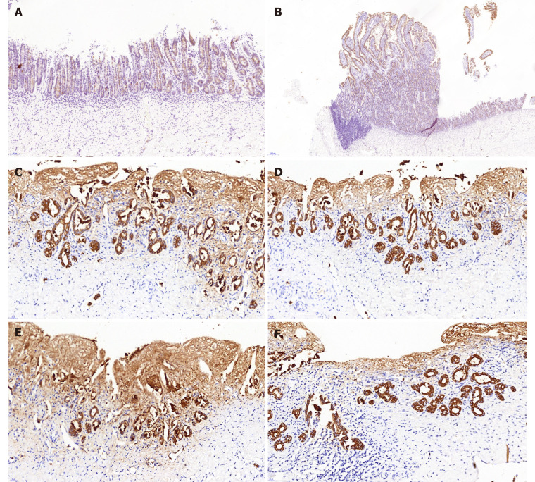 Cytokeratin 19 immunostaining. The cytokeratin 19 (CK19) staining showed no marked differences between the animal-derived artificial bile duct site and the normal bile duct on the aspect of bile duct epithelium and accessory glands on the inner wall. The superior integrity of regeneration of the biliary epithelial layer was observed in group B than that in group A. A: CK19 staining of the animal-derived artificial bile duct site in group A (magnification: 20 ×); B: CK19 staining of duodenal papilla in group A (magnification: 20 ×); C and D: CK19 staining of the animal-derived artificial bile duct site in group B (magnification: 40 ×); E and F: CK19 staining of the distal normal bile duct in group B (magnification: 40 ×).