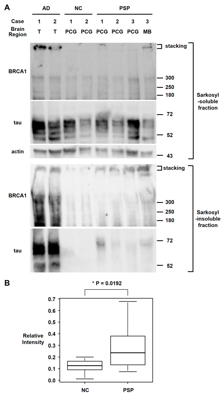 Western blot analyses of the sarkosyl fractionated human brain samples. (A) Sarkosyl-soluble fraction of brain samples showed similar intensity bands of full-length BRCA1 (≈300 kDa) among the AD, NC, and PSP brain samples, with high intensity stacking observed in 2 AD brain samples and 1 PSP midbrain sample. In the sarkosyl-insoluble fraction, tau bands were only observed in AD and PSP brain samples. Sarkosyl-insoluble full-length BRCA1 (≈300 kDa) was observed in both AD samples as previously described. Although sarkosyl-insoluble full-length BRCA1 monomer band intensities in PSP samples were higher than in the NC in only 1 midbrain sample, the stacking intensities were higher in PSP samples, which suggests BRCA1 aggregation. T: temporal cortex, PCG: precentral gyrus, MB: midbrain. (B) Quantification of sarkosyl-insoluble BRCA1 signal at ≈300 kDa. Intensity relative to the average intensity of AD samples is shown in box and whisker plots. Although much less than AD, PSP brain samples showed significantly more insoluble BRCA1 than NC.