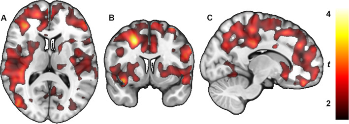 Whole‐brain statistical parametric mapping analysis shows lower type 1 cannabinoid receptor density (distribution density) in subjects with Parkinson's disease when they were off antiparkinsonian medication compared with being on their usual medication. Color bar represents t value, which corresponds to the level of significance at the voxel level. (A) Transaxial section. (B) Coronal section. (C) Sagittal section.
