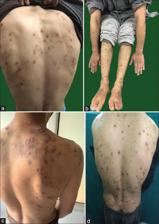 Prurigo and prurigo nodularis in patients secondary to pruritus among heroin users over back (a, c and d) and extremities (b)