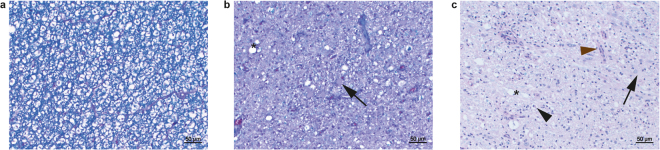 Histopathology of the spinal cord of LEMP-affected dogs. Combined luxol fast blue/hematoxylin & eosin stain of paraffin sections. (a,b) Spinal cord sections of previously described11 Rottweiler case R2 showing deep blue staining of the normal myelin in an unaffected area (a) and an affected spinal cord area (b) exhibiting loss of blue myelin staining, vacuoles (asterisk), and large gemistocytic astrocytes (arrow). (c) Affected spinal cord area of the previously described Rottweiler case R112 exhibiting severe loss of blue myelin staining, vacuoles (asterisk), infiltration by macrophages (black arrowhead), capillary hypertrophy (brown arrowhead) and large gemistocytic astrocytes (arrow).