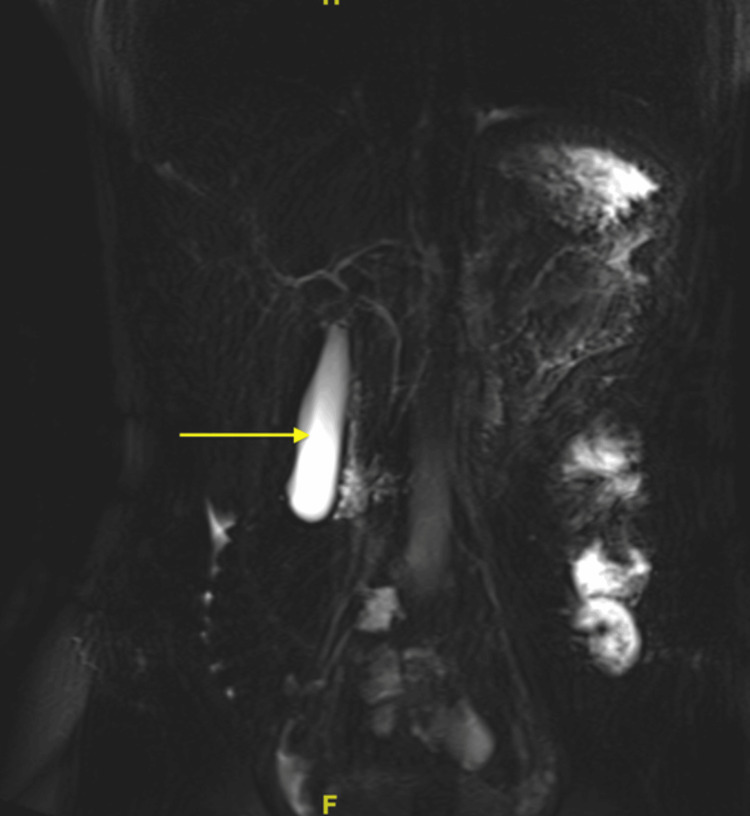 Magnetic resonance cholangiopancreatography (MRCP) reveals the right and left common biliary ducts without abnormalities. There is a distended gallbladder present with no thickening.