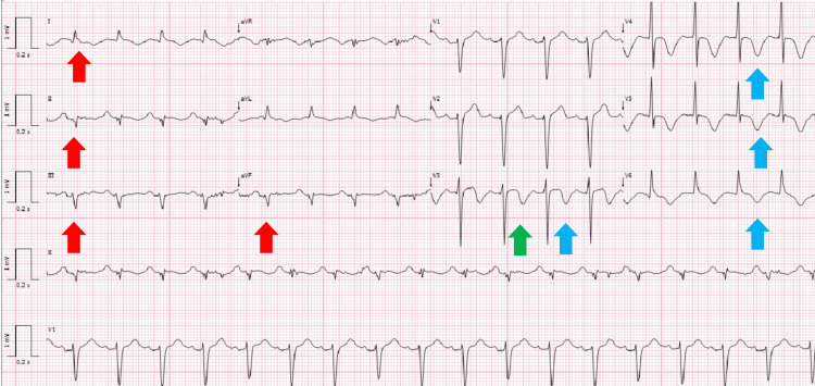 Electrocardiogram demonstrating a left anterior fascicular block (red arrows), T-wave inversion in the precordial leads (blue arrows), and a prolonged QTc interval (green arrow).
