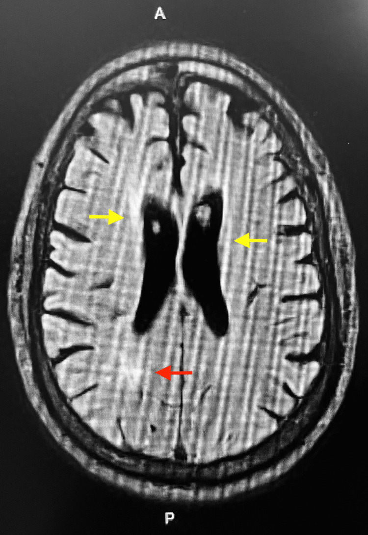 Alternative transverse sequence of MRI Brain showing increased T2 signal within the periventricular (yellow arrows) and subcortical (red arrow) white matter; characteristic of toxic leukoencephalopathy.