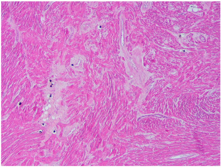 Wavering of myocardial fibers, fibrosis and disarray in the left ventricle myocardial area above the myocardial bridging (Hematoxylin and eosin stain, 200× magnification).