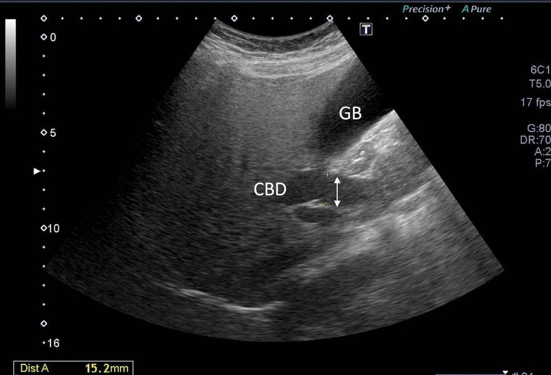 Abdominal ultrasonography showed dilated common bile duct up to 15.2 mm without obvious stones nor mass.