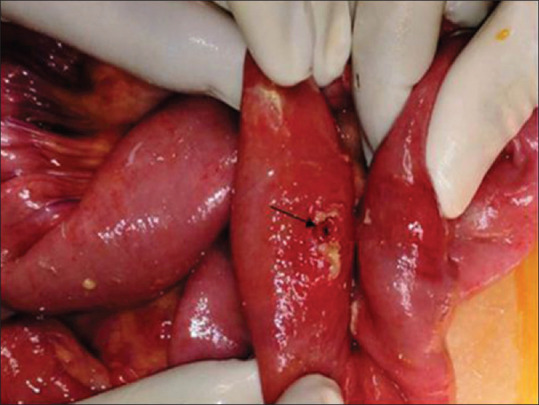 Intraoperative picture showing jejunal perforation
