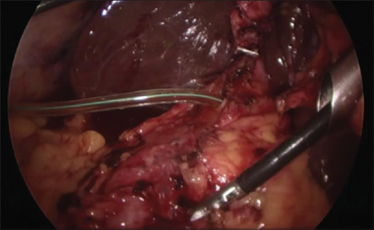 Common bile duct closure over T-tube